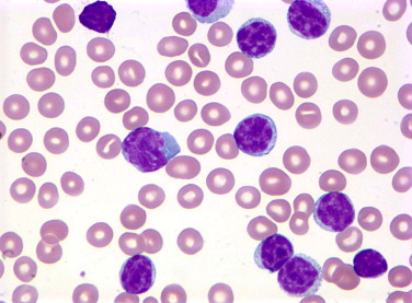 Leukemia Limfositik Kronis