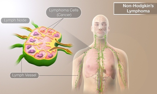 Limfoma Non-Hodgkin