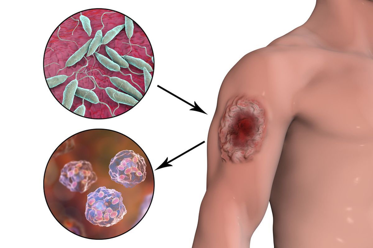 Leishmaniasis