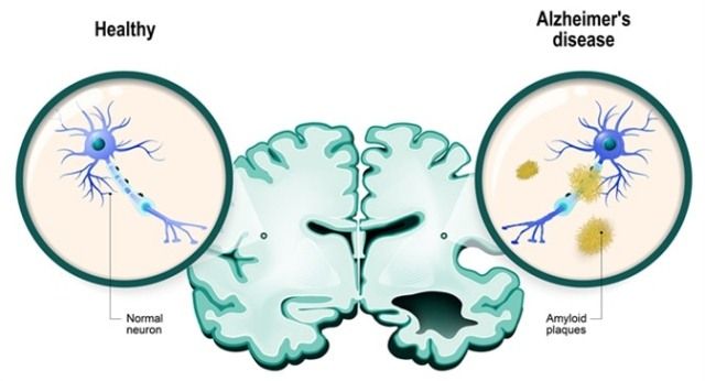 Penyakit Alzheimer