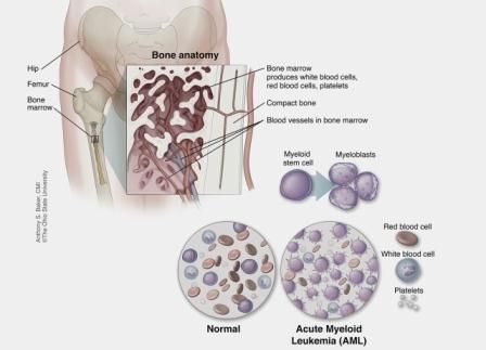 Leukemia Mieloid Akut