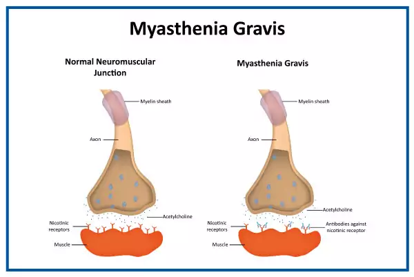 Miastenia Gravis