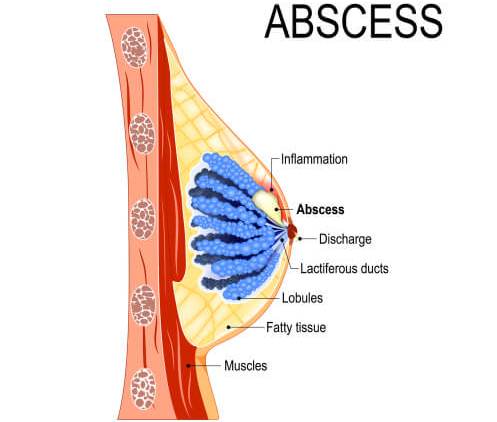 Infeksi dan Abses Payudara