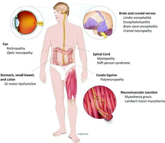 Sindroma Paraneoplastik