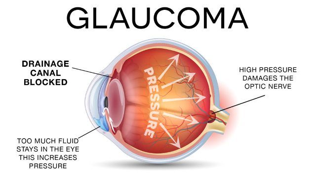 Glaukoma