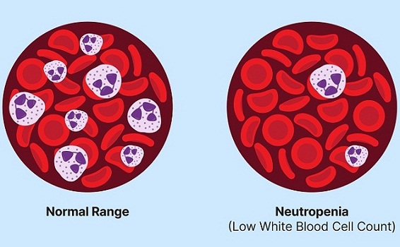 Neutropenia