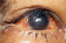 Trichiasis