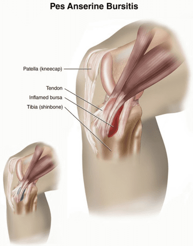 Pes Anserine Bursitis