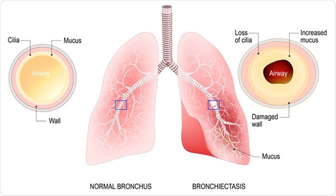 Bronkiektasis