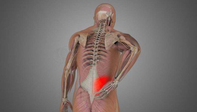 Cedera Pinggang (Lumbar Strain)