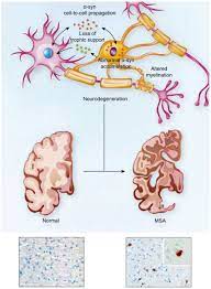 Multiple System Atrophy