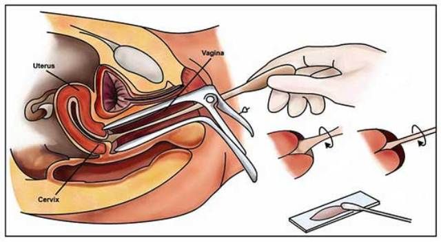 Pemeriksaan Pap Smear