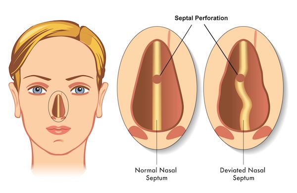 Perforasi Septum