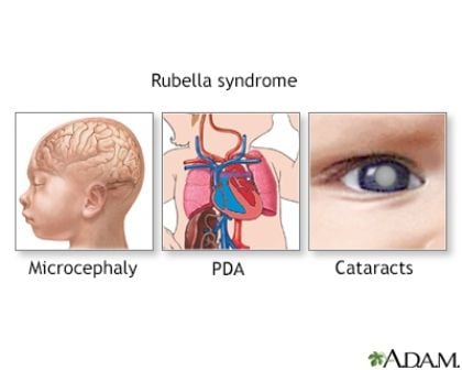 Campak Jerman (Rubella) Kongenital