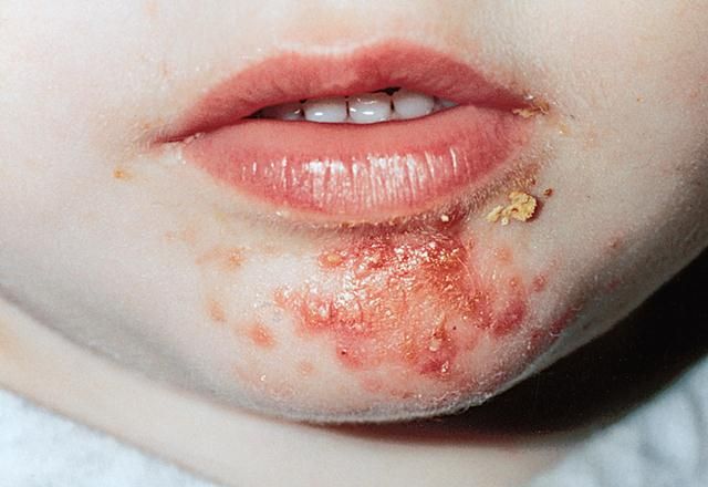 Impetigo