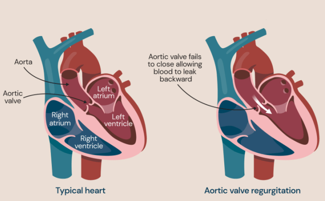 Regurgitasi Katup Aorta