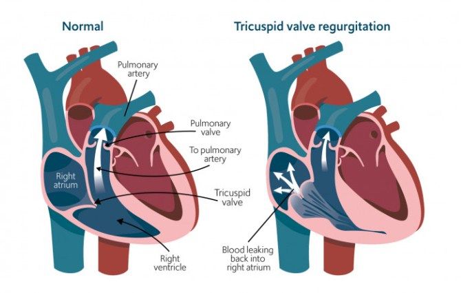 Regurgitasi Katup Trikuspid