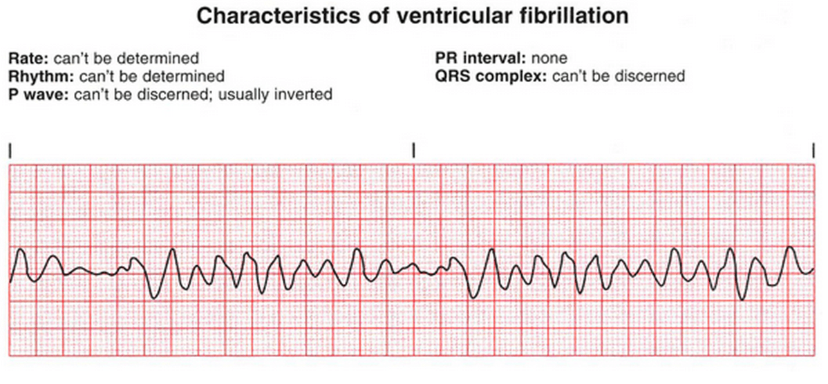 Fibrilasi Ventrikel