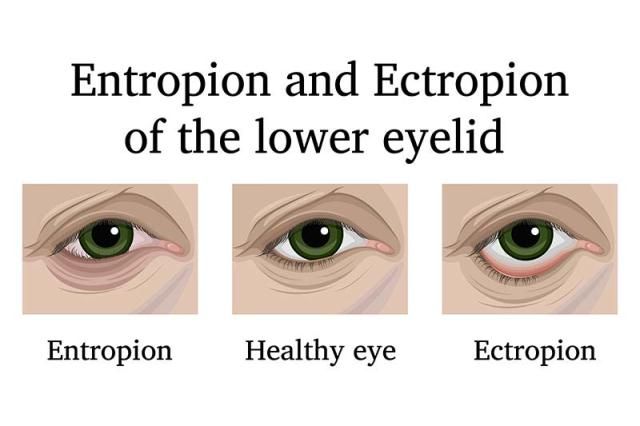 Entropion dan Ektropion