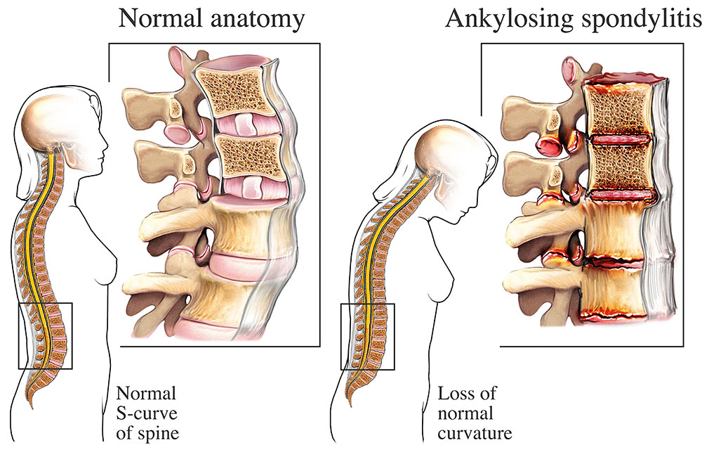 Ankylosing spondylitis (AS)