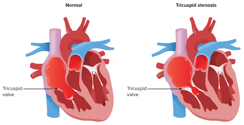 Stenosis Katup Trikuspid