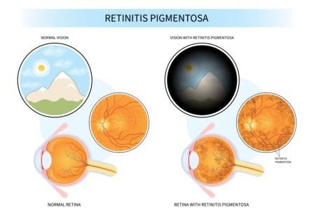 Retinitis Pigmentosa