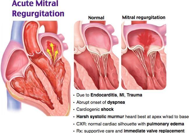 Regurgitasi Katup Mitral