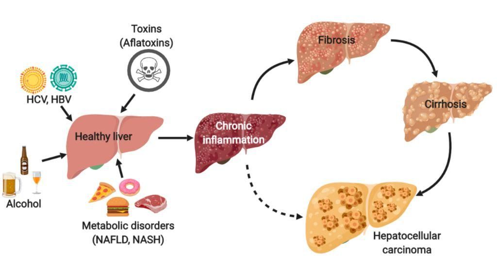 Hepatoma (Karsinoma Hepatoseluler)