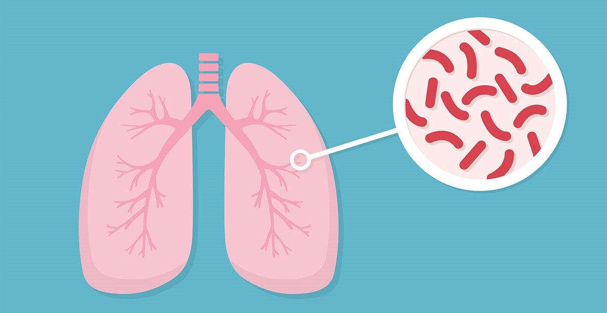 Tuberkulosis pada Bayi