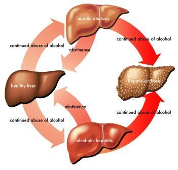 Penyakit Hati karena Alkohol (Hepatitis Alkoholik)