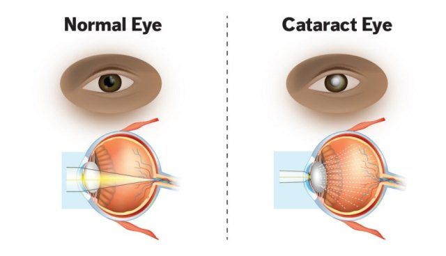 Katarak