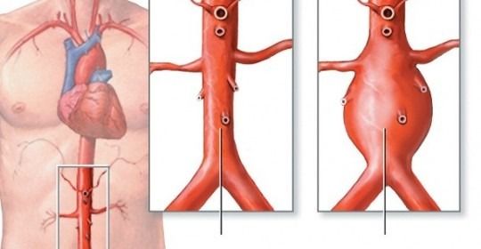 Aneurisma Aorta Abdominal