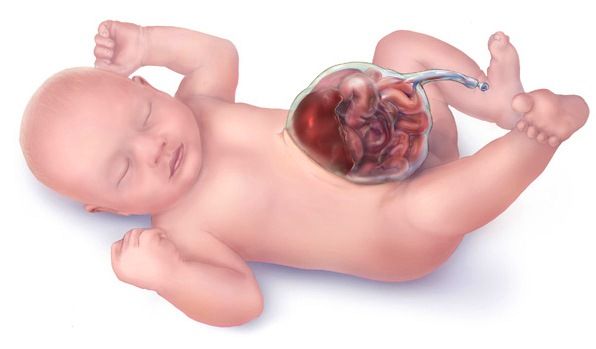 Kelainan Dinding Perut - Omphalocele