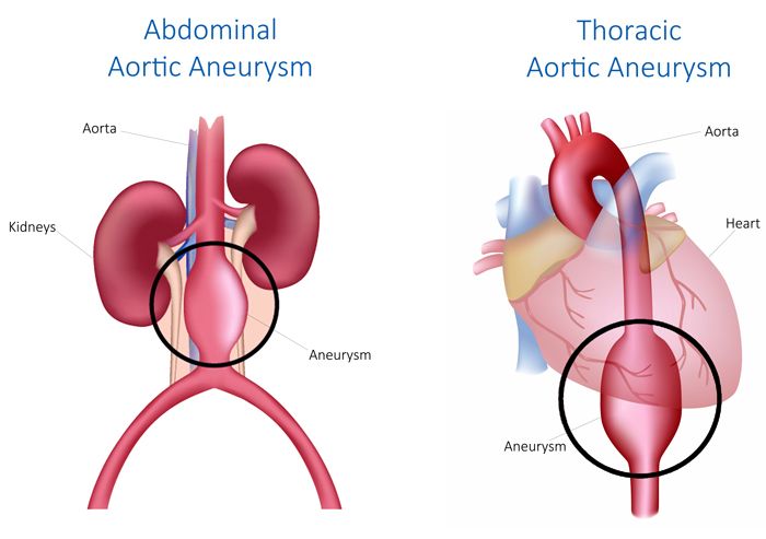 Aneurisma Aorta Torakalis