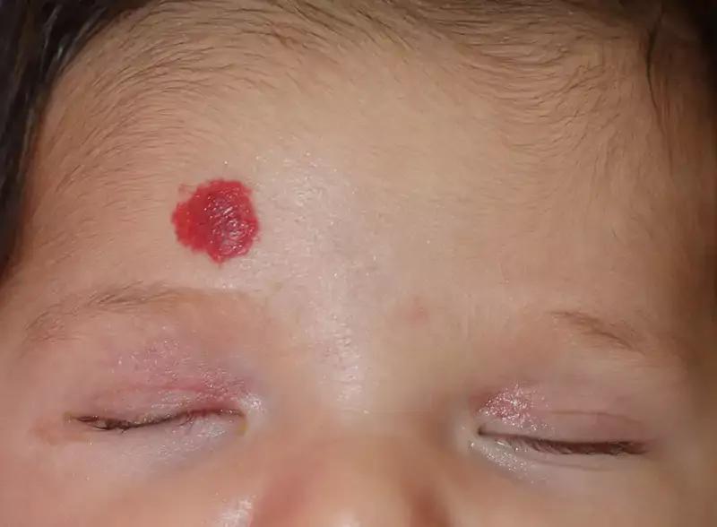 Hemangioma (Tumor Pembuluh Darah)