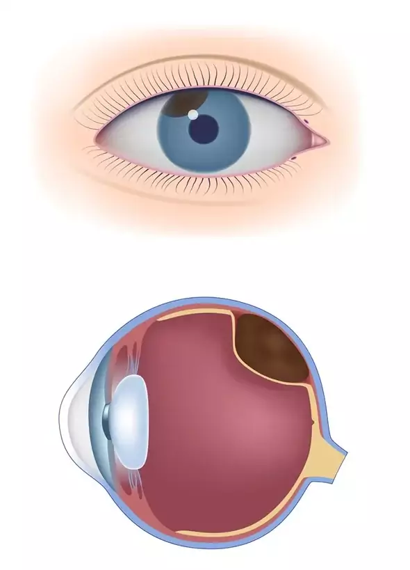 Melanoma Koroid