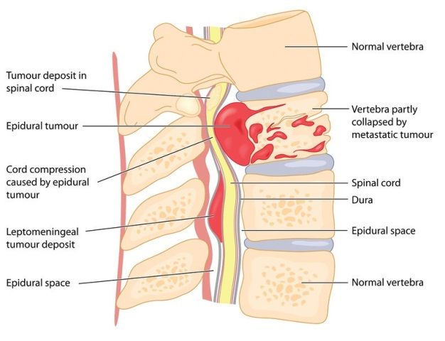 Tumor Medulla Spinalis