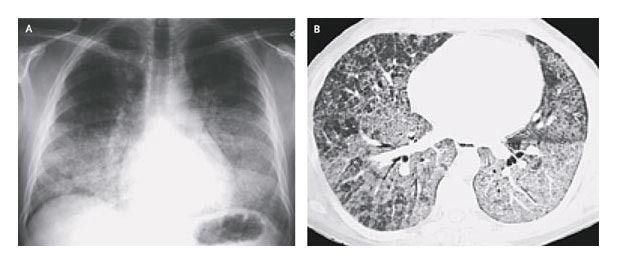 Proteinosis Alveolar Pulmoner