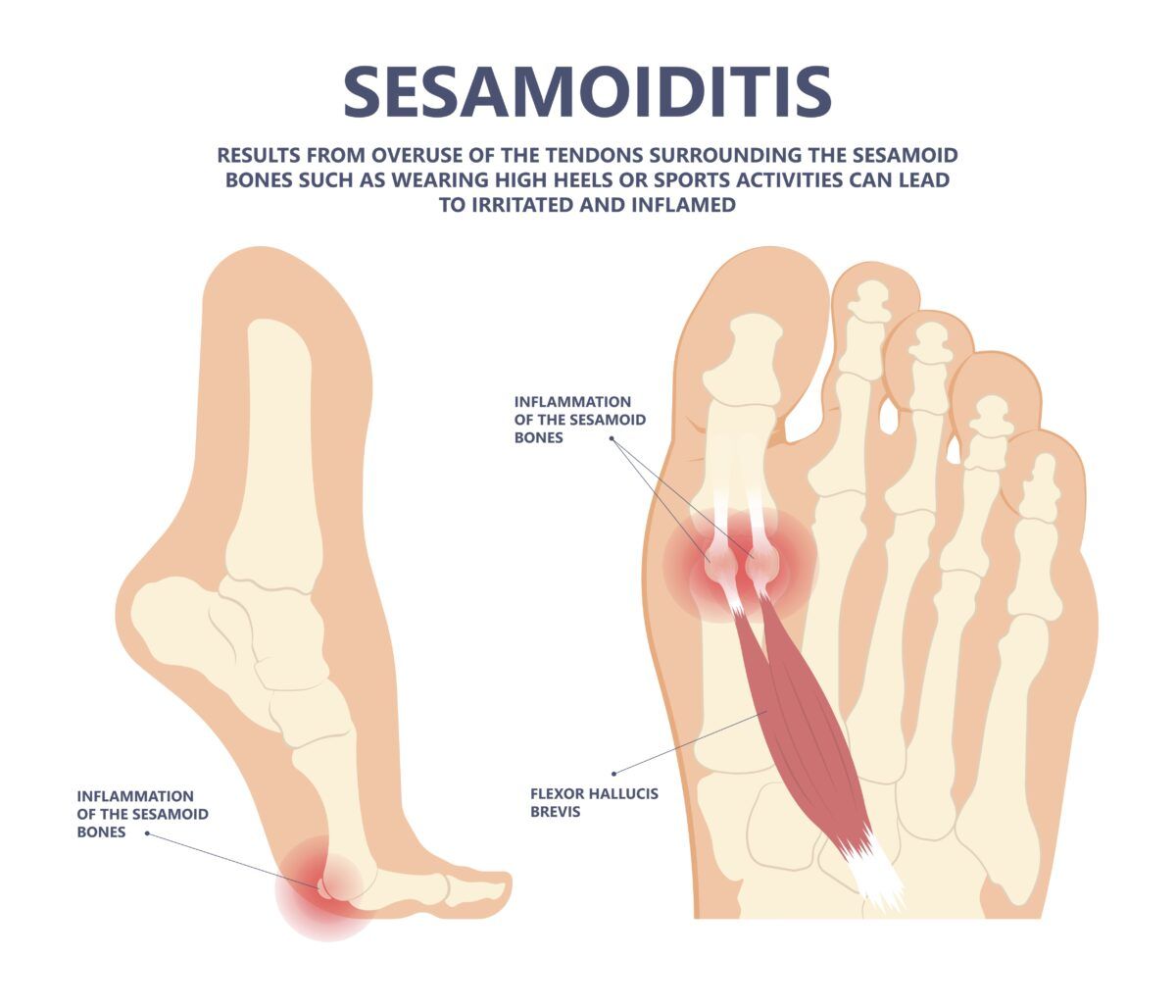 Sesamoiditis