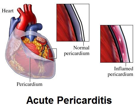 Perikarditis Akut