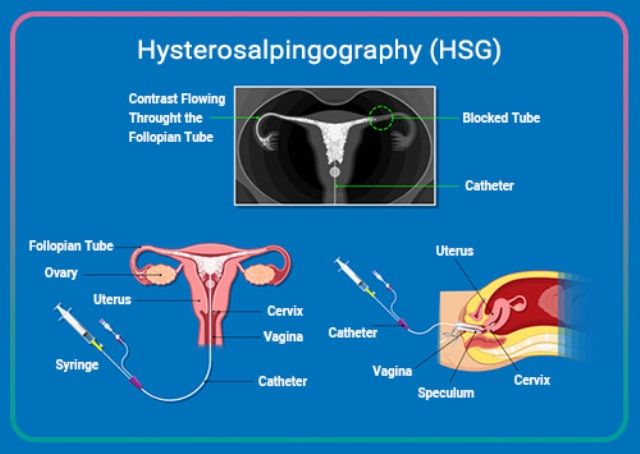 Hysterosalpingography