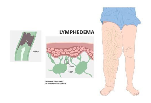 Filariasis atau Elephantiasis (Kaki Gajah)