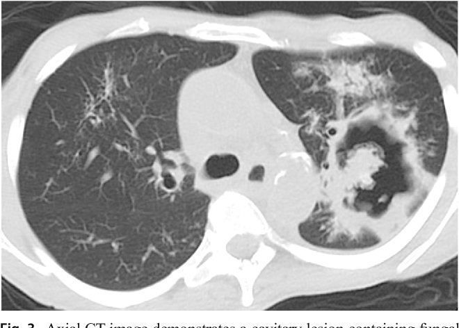 Pneumonia Jamur