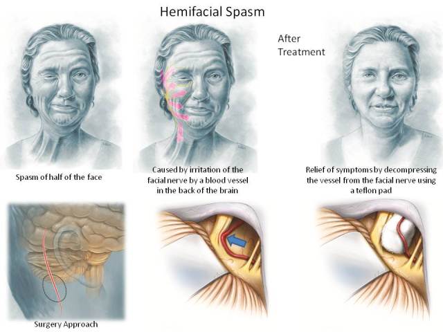 Kejang hemifacial (Hemifacial Spasm)