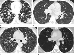 Granulomatosis Wegener Pulmonal