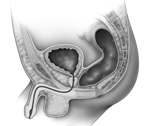 Atresia Anus