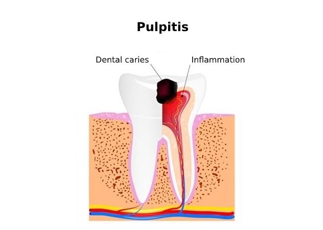 Pulpitis (Radang Pulpa Gigi)