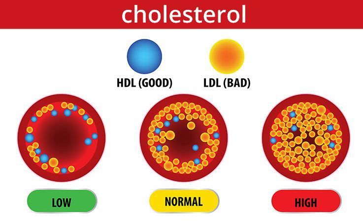 Hiperlipidemia, Kolesterol Tinggi, Trigliserida Tinggi