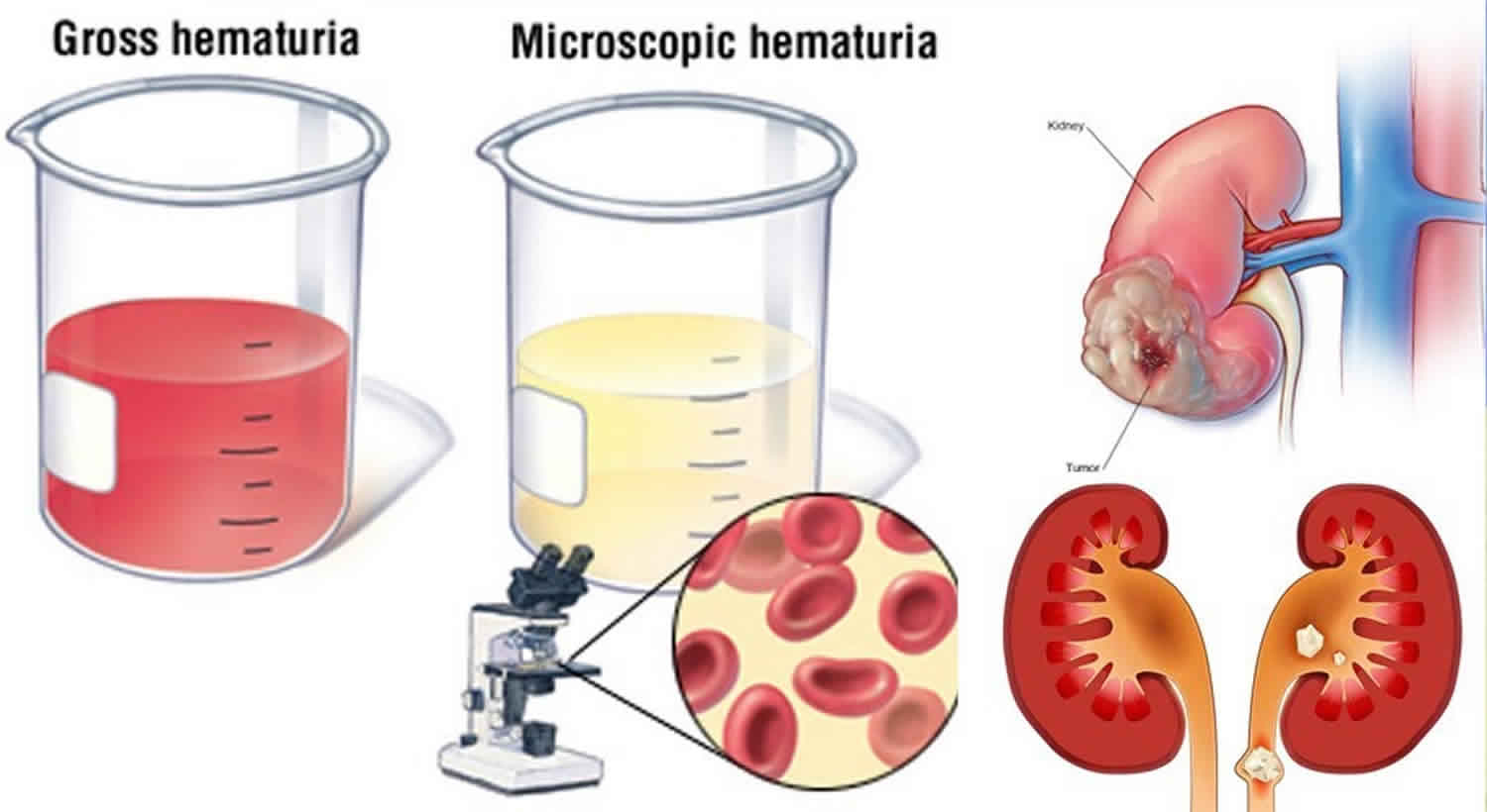 Hematuria (Darah dalam Urin)