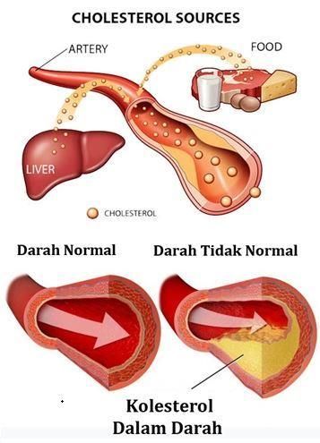 Gangguan Metabolisme Lemak